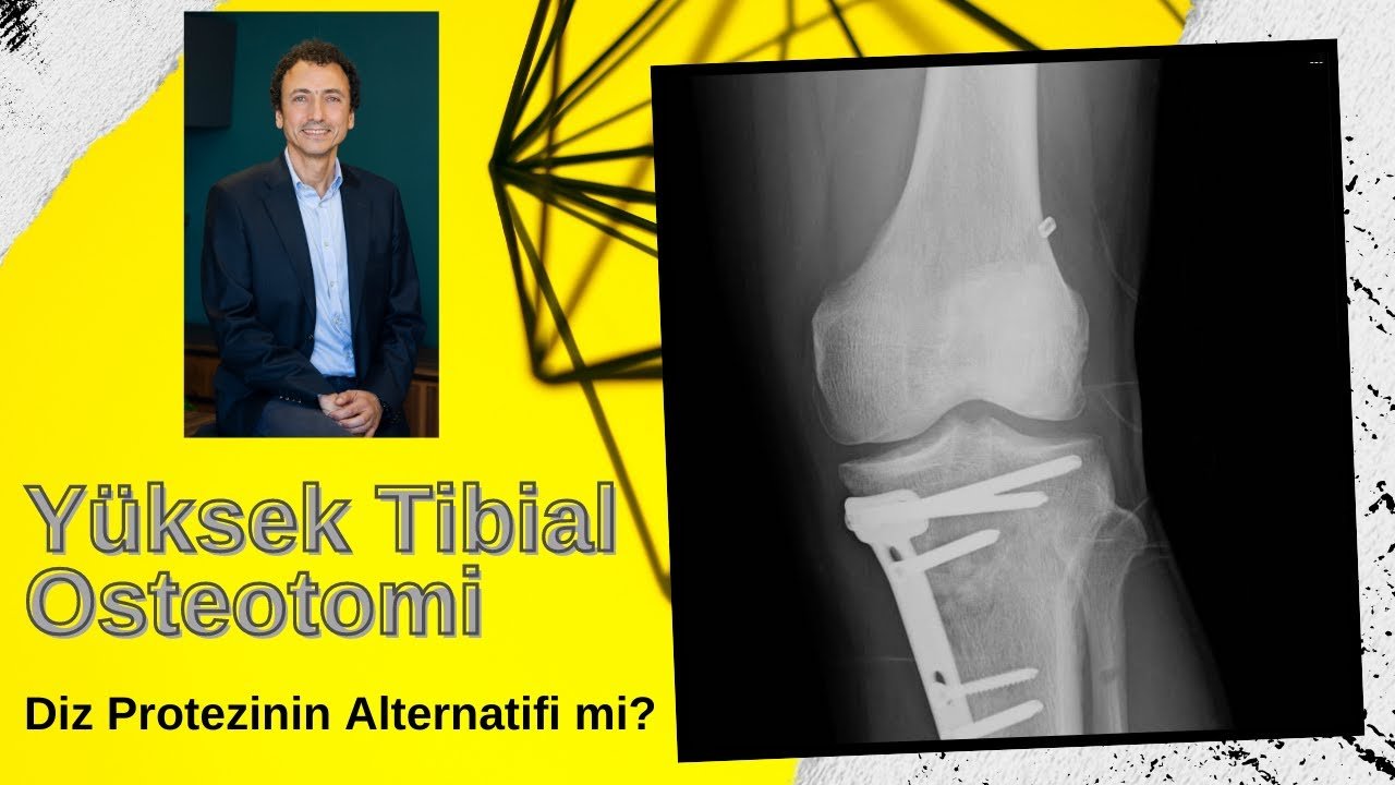 Yüksek Tibial Osteotomi, Diz Protezinin Alternatifi mi?